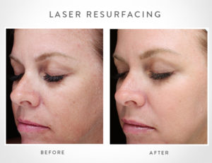 LaserResurfacing_before_after
