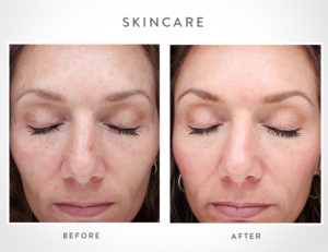 Skincare_before_after